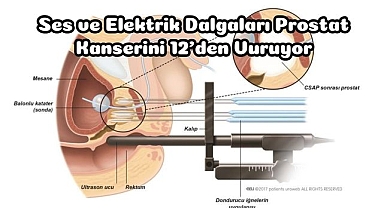 Ses ve Elektrik Dalgaları Prostat Kanserini 12’den Vuruyor