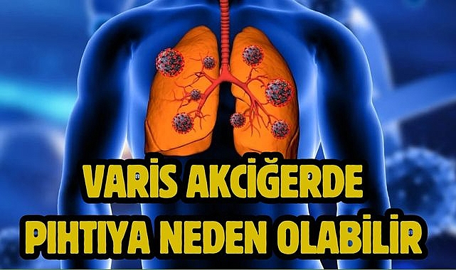 VARİS AKCİĞERDE PIHTIYA NEDEN OLABİLİR 